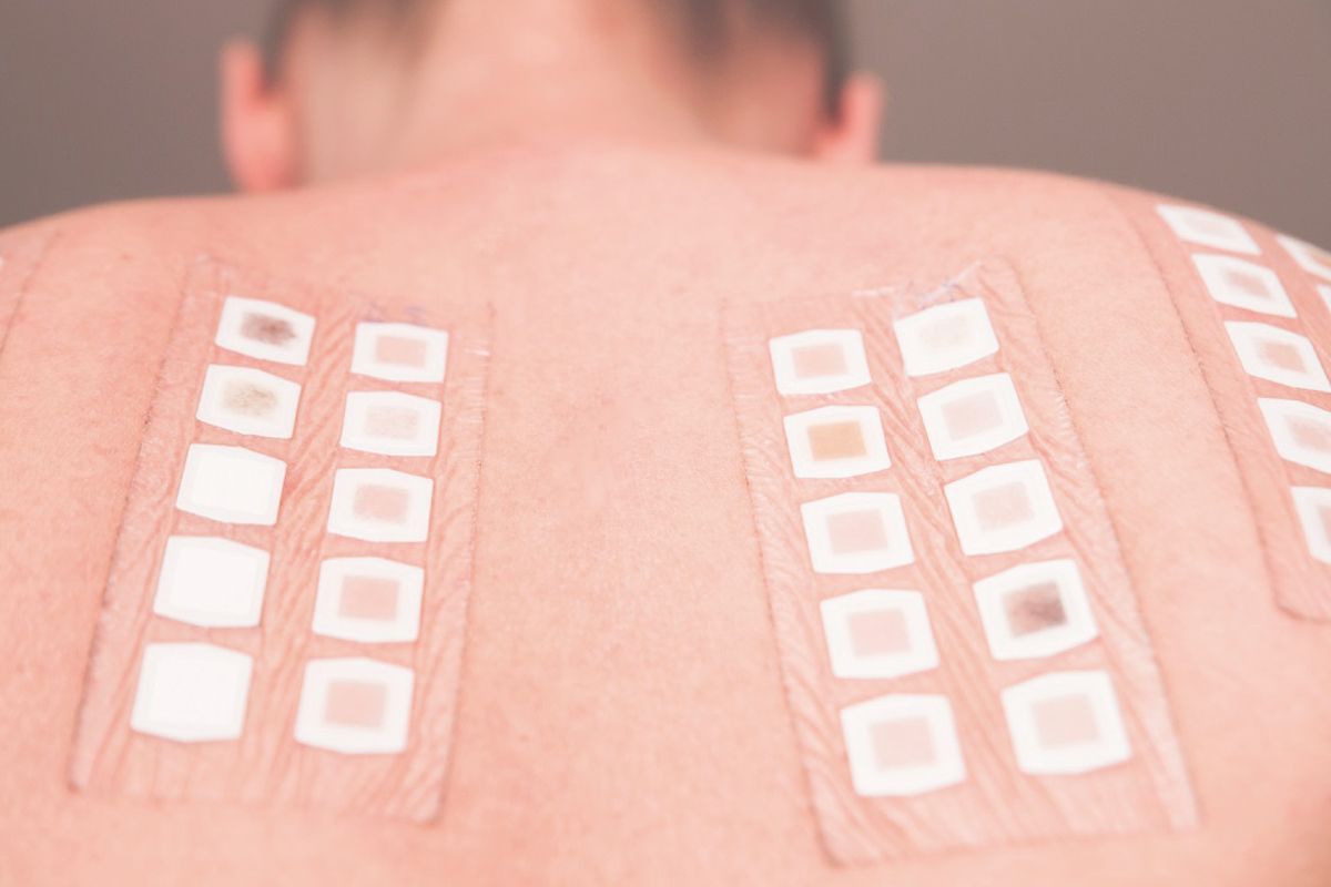 Cerotti dei test allergologici epicutanei applicati sulla schiena