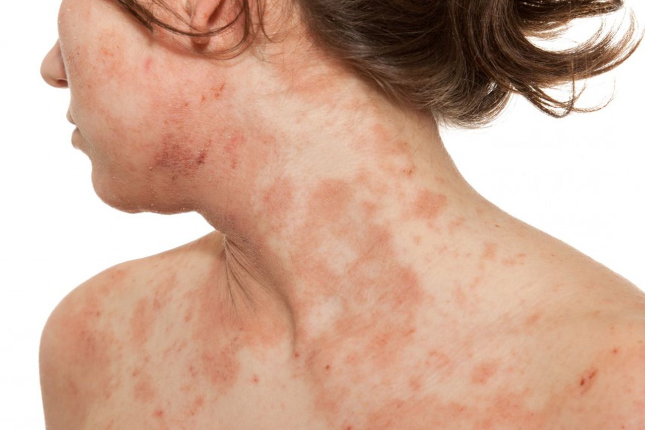Dermatite su volto e collo