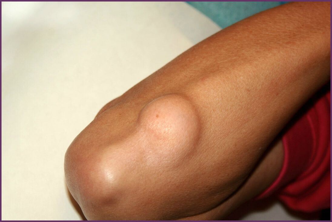 Lipoma sul braccio