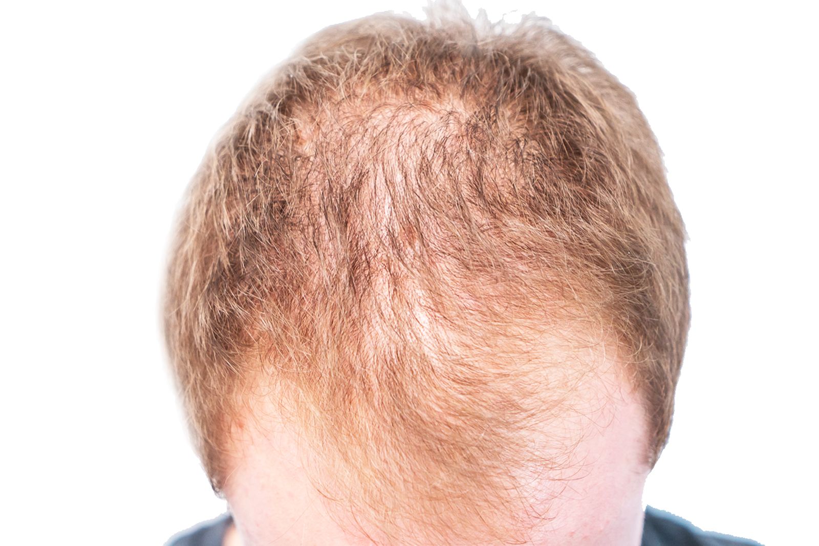 Valutazione di un diradamento dei capelli
