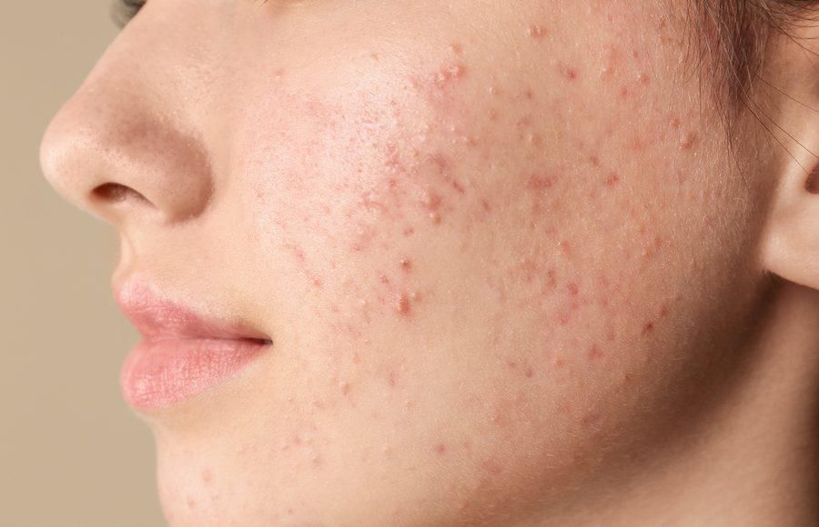 Acne infiammatoria sul volto