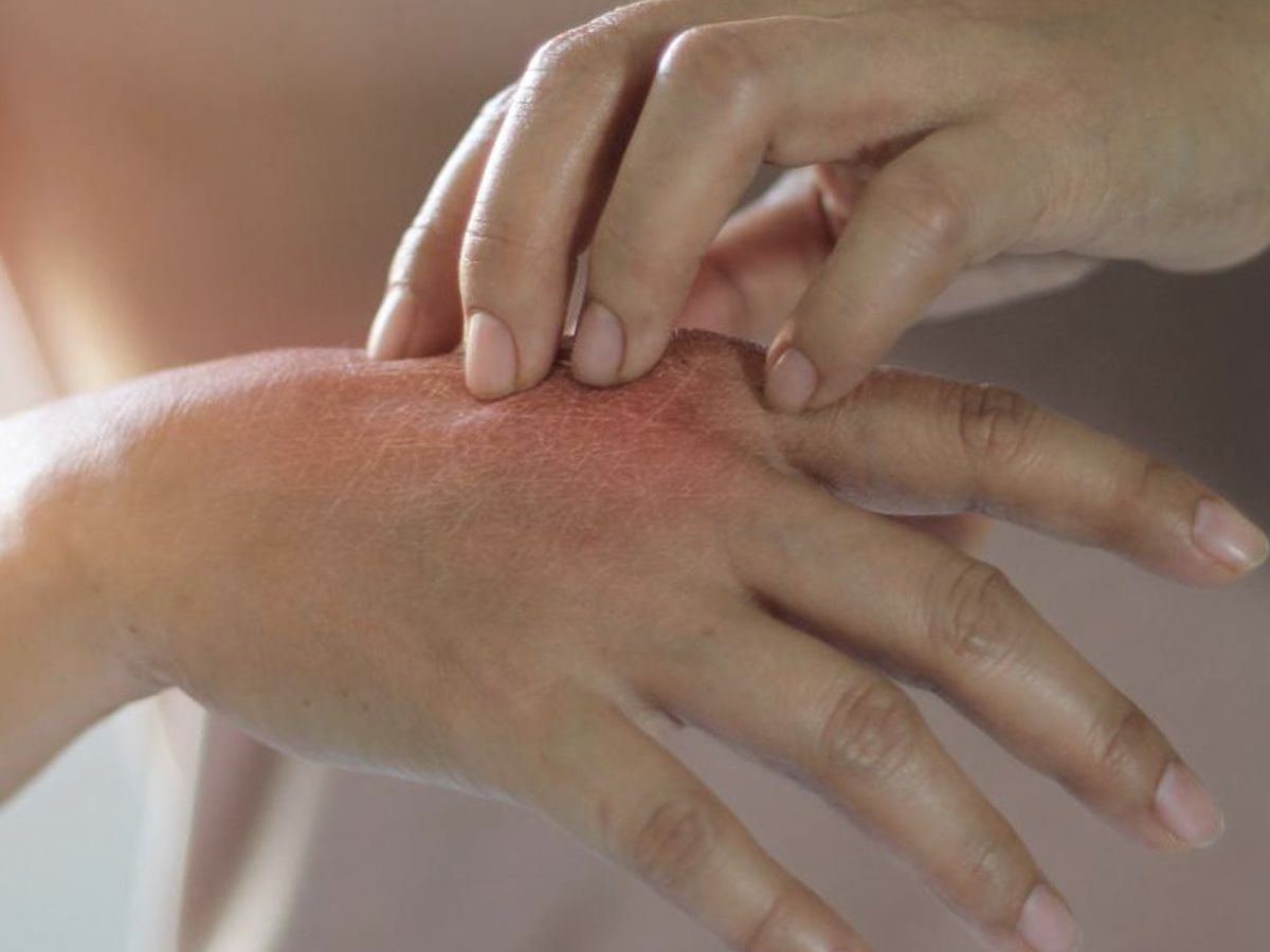 Mano con dermatite allergica da contatto