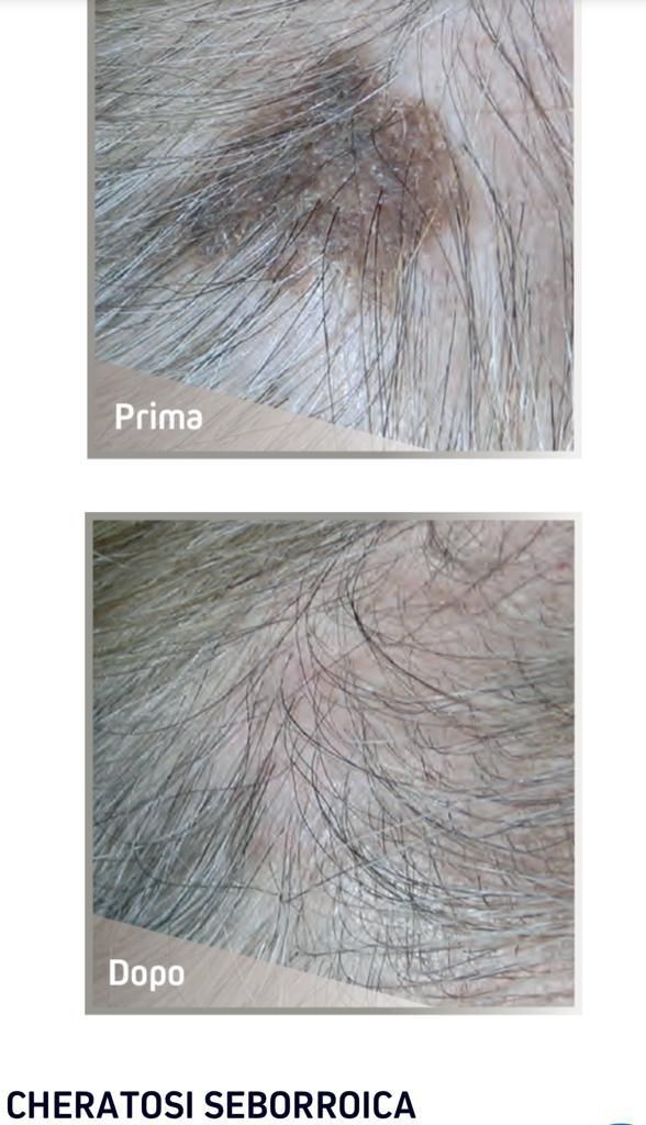 Cheratosi seborroica prima e dopo il laser