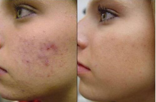 Cicatrici da acne prima e dopo il trattamento