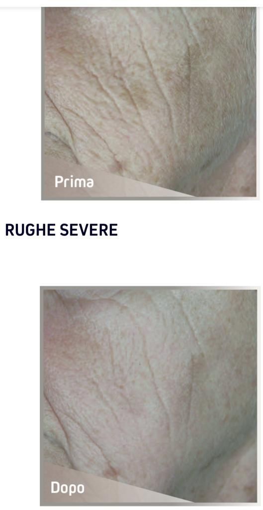Rughe profonde prima e dopo il laser