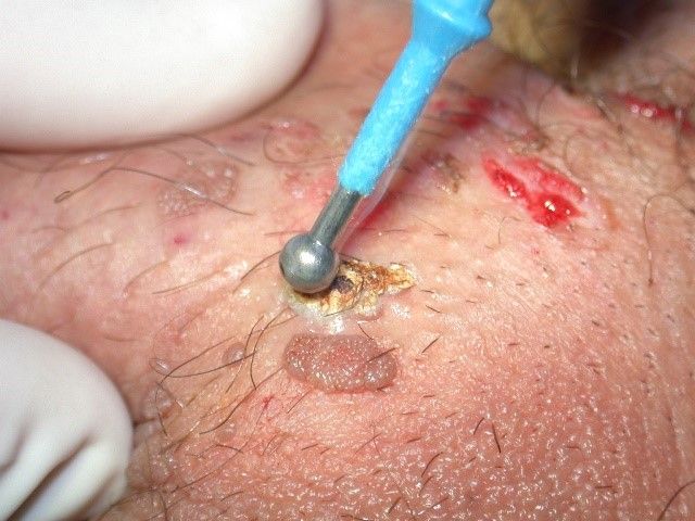 Trattamento di elettrochirurgia