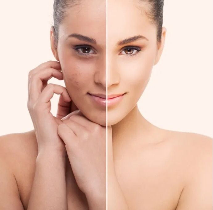 Prima e dopo il trattamento dell'acne